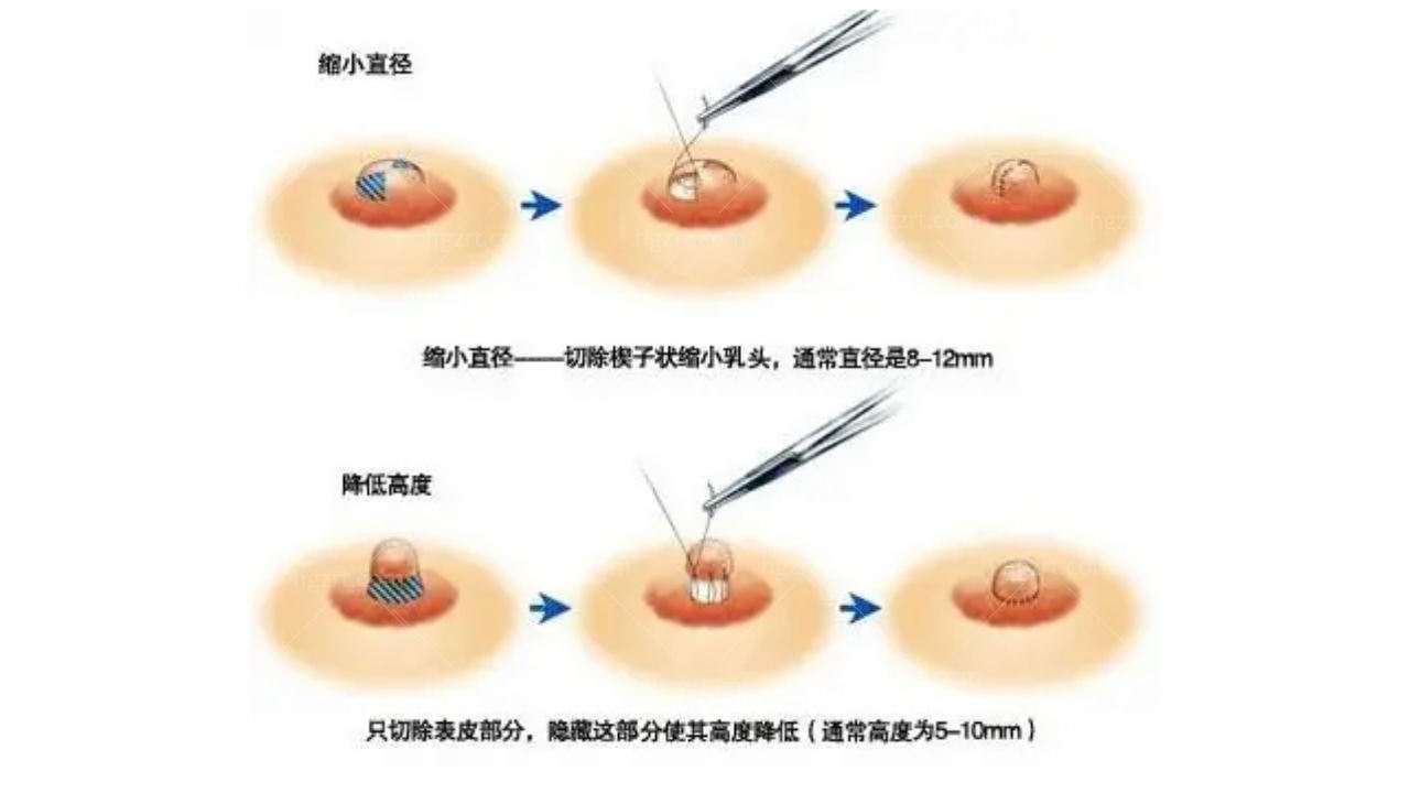 内陷乳头矫正和3D乳头缩小术之间的区别是什么？