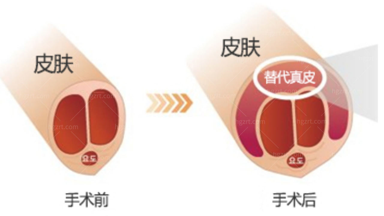 韩国世檀塔男科医院的SST阴茎增大技术