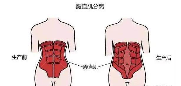 崔鑫医生腹壁成形手术大概需要多少钱？