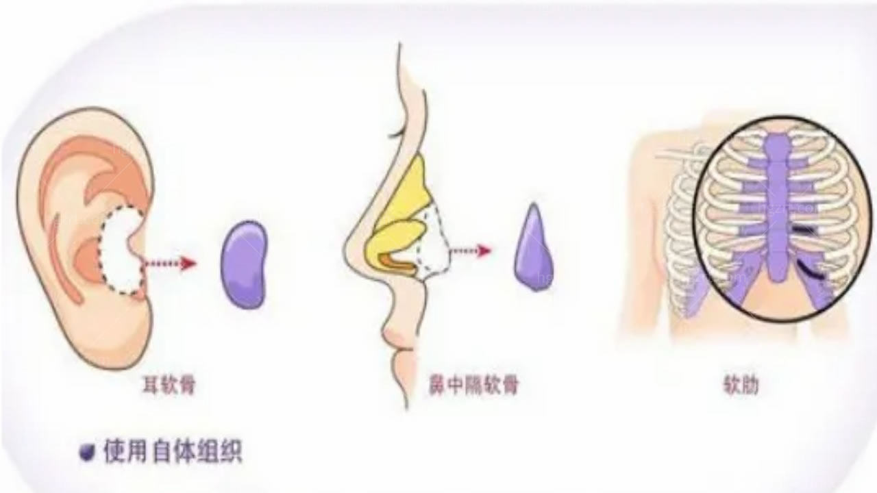 鼻部整形的材料选择耳软骨/鼻中隔软骨/肋软骨哪种好？