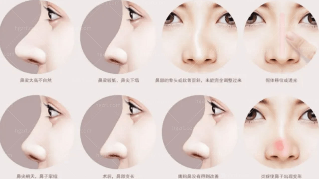 韩国鼻尖整形有哪些方式?动感/自体组织鼻尖区别秒辨！