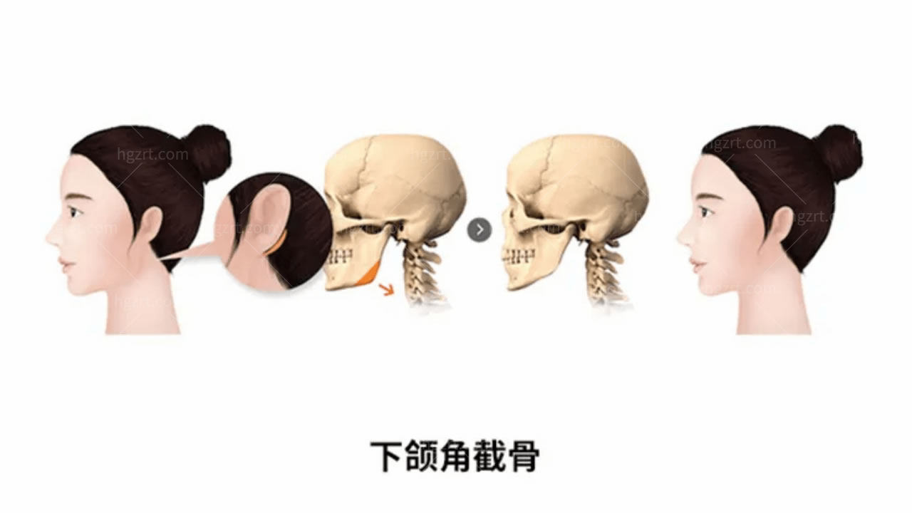 韩国下颌角截骨和长曲线的区别！适应人群有哪些？