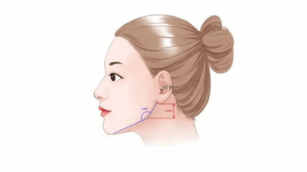 韩国下颌角截骨和长曲线的区别！适应人群有哪些？