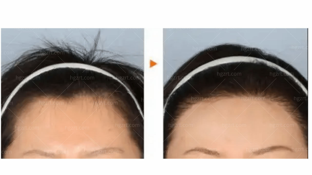 韩国眉毛移植和发际线矫正哪个好？哪家医院做的好？