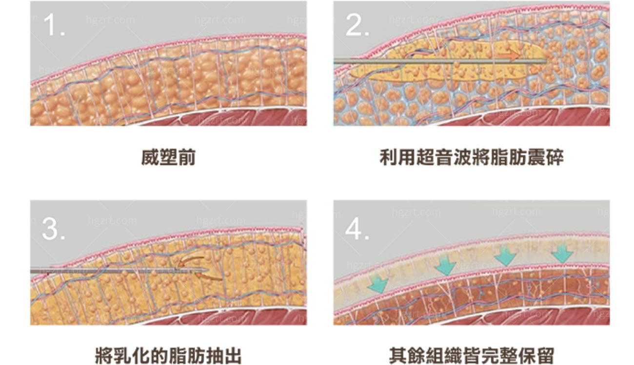 什么是5D雕刻手术.jpg