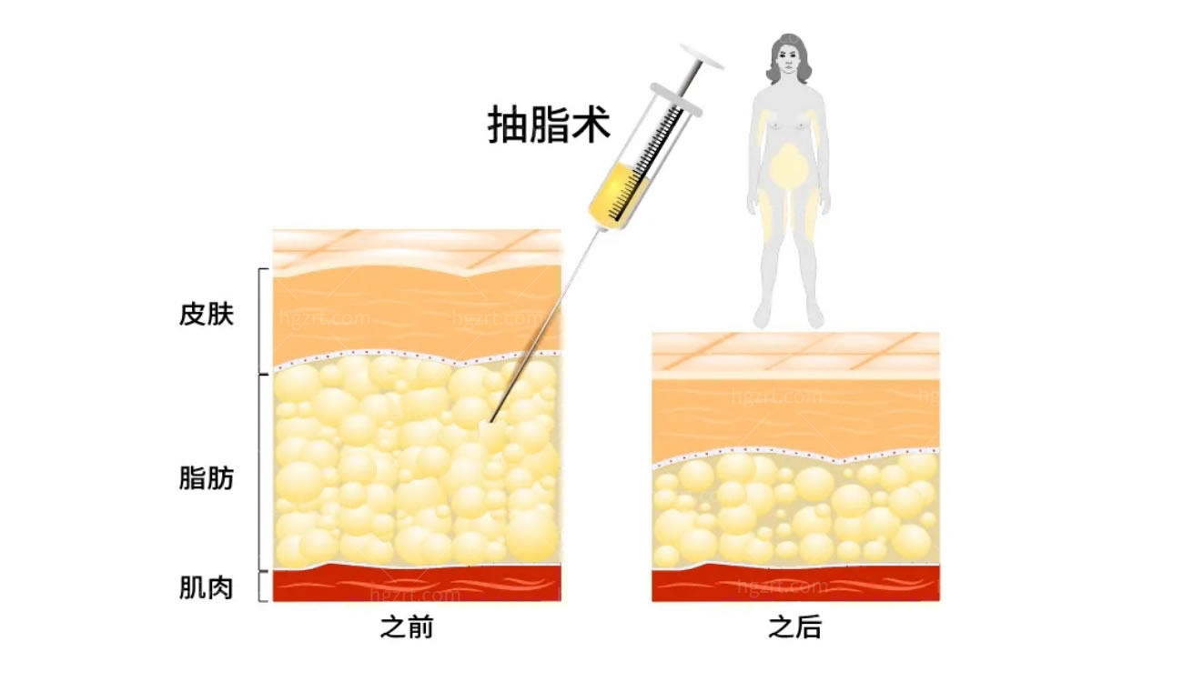 韩国吸脂去双下巴怎么样.jpg