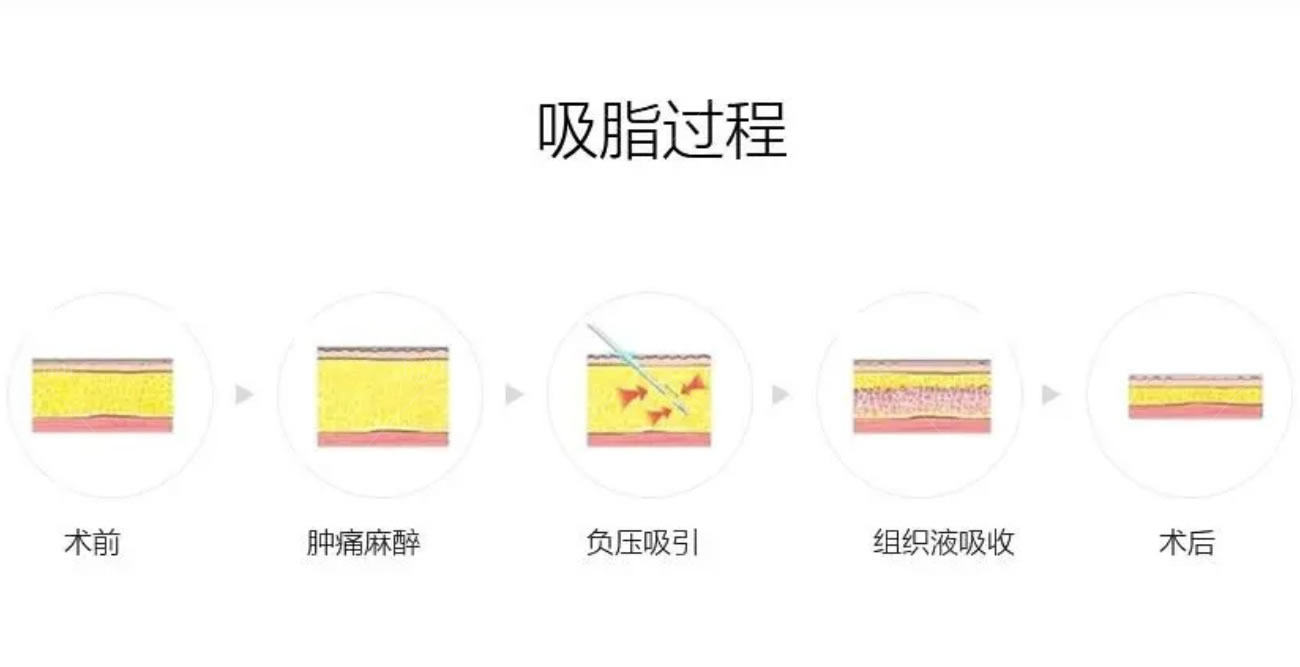 韩国吸脂去双下巴怎么样.jpg