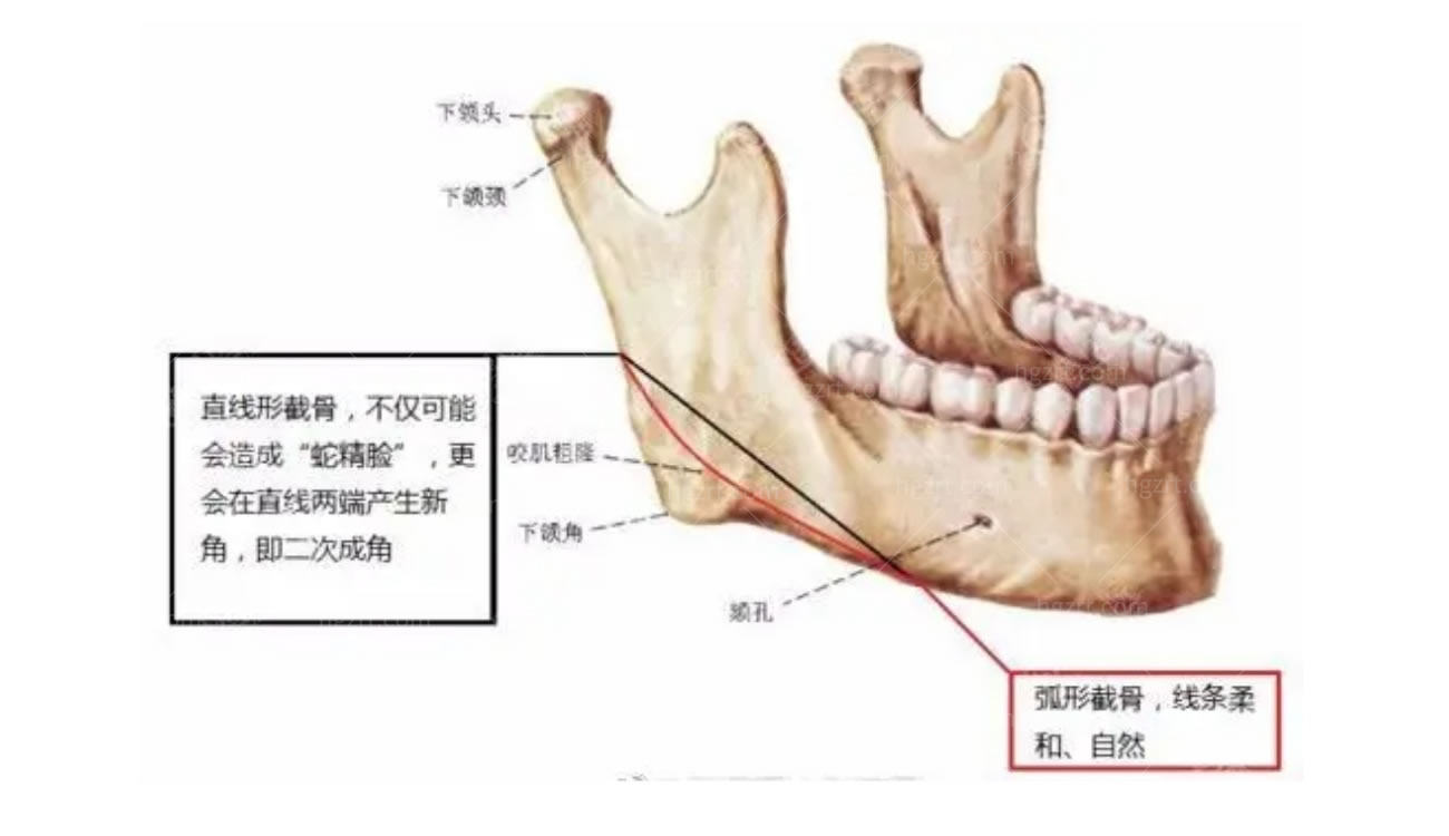 韩国面部轮廓手术.jpg