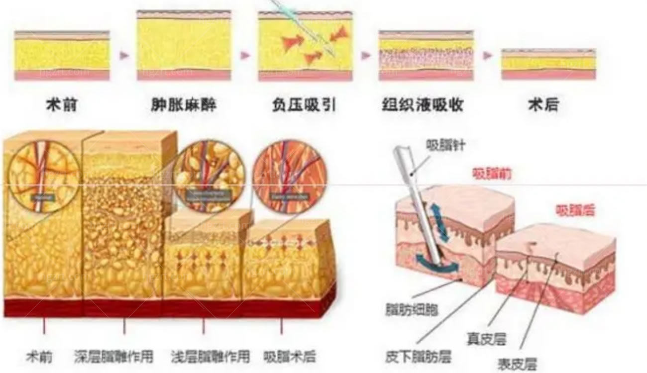 吸脂手术.jpg