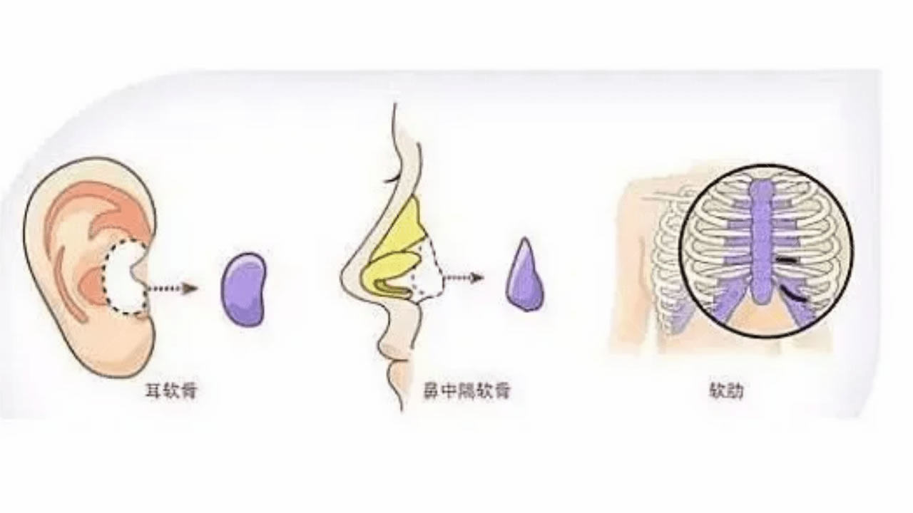 韩国肋软骨和鼻中隔软骨、耳朵软骨哪个好？区别是什么？