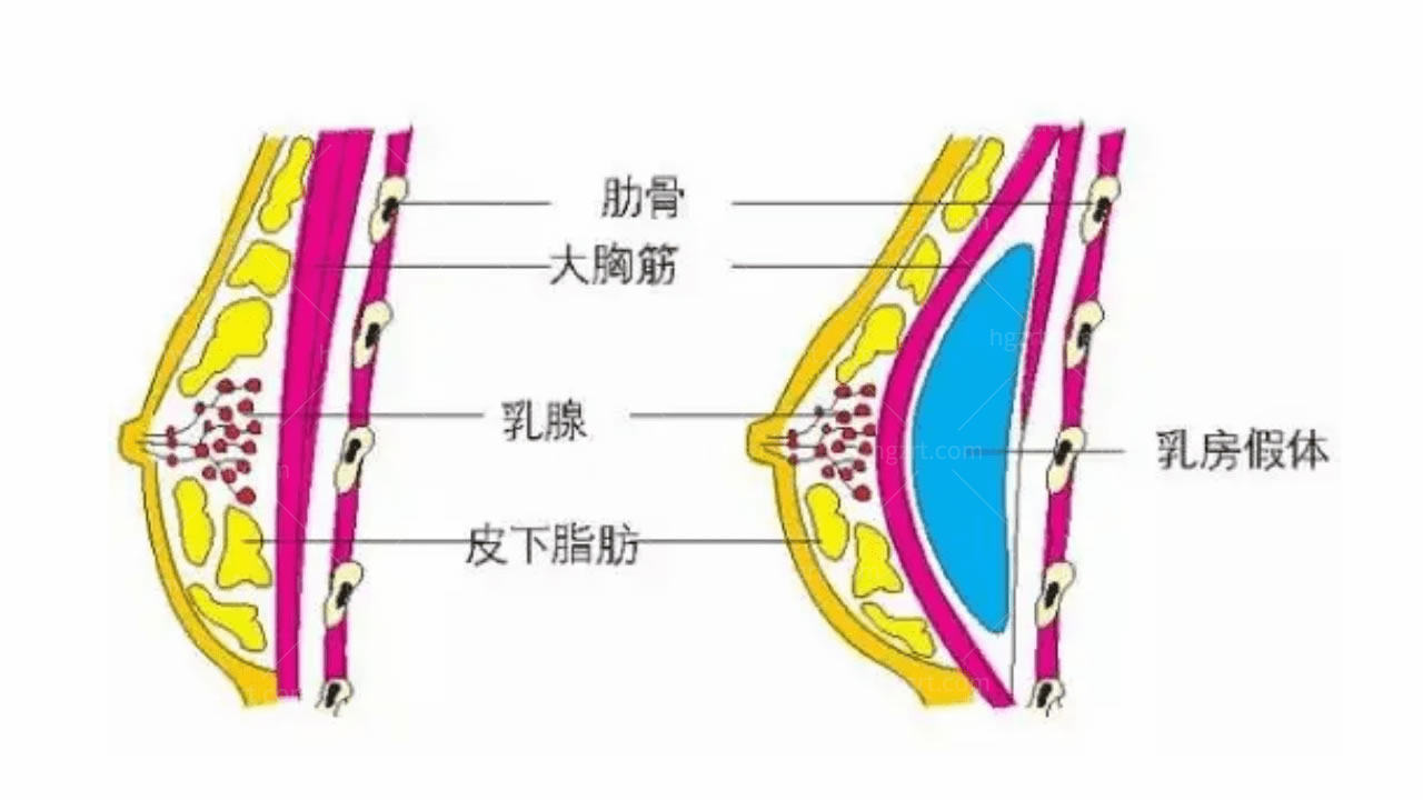 韩国内窥镜隆胸的优点和缺点？你知道哪些？