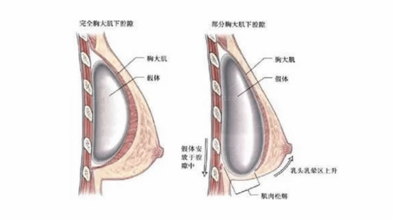 韩国内窥镜隆胸的优点和缺点？你知道哪些？