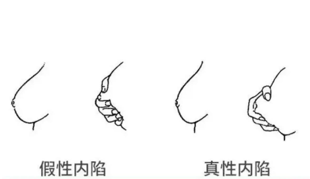 韩国胸部整形手术方法.jpg