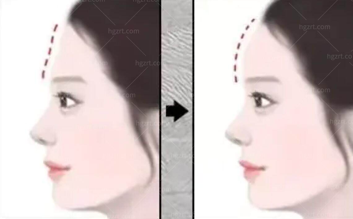 韩国的面部轮廓手术