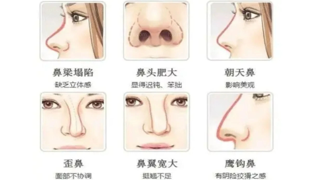鼻修复手术会遇到的常见问题.jpg