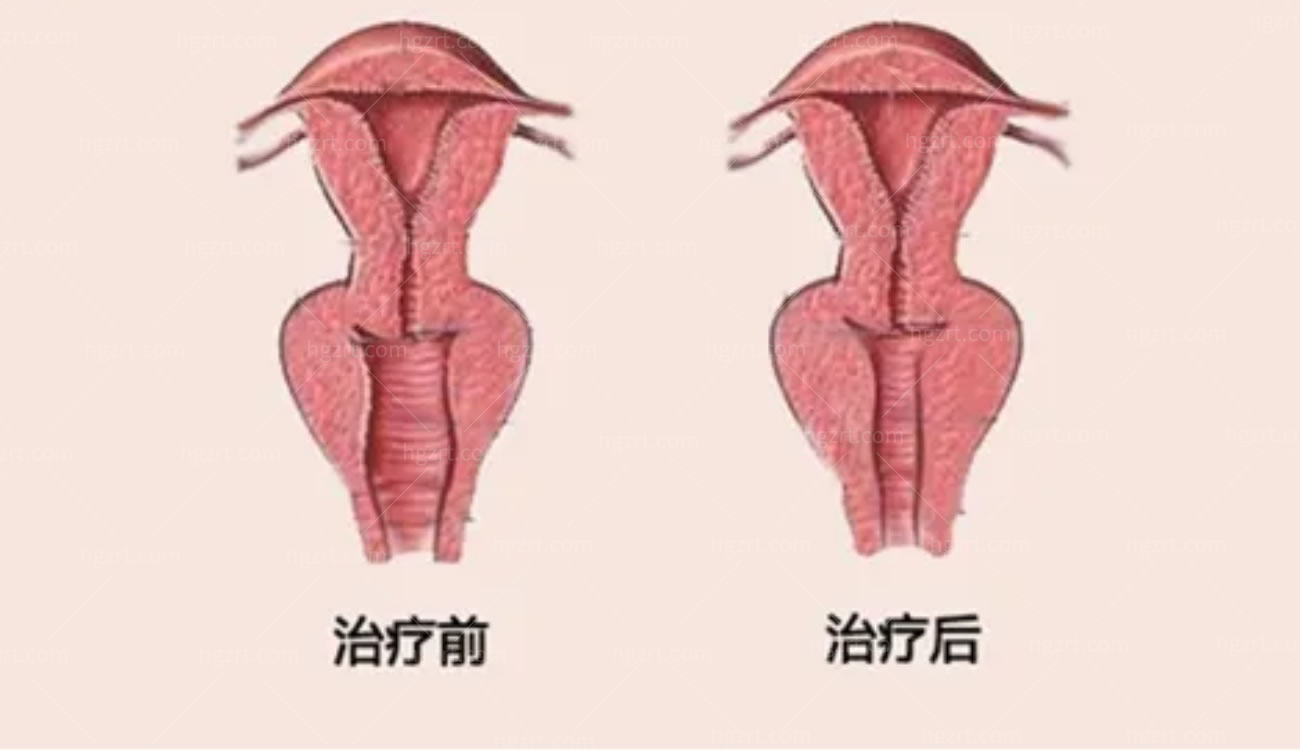 后方膣圆盖术特有的手术反响.jpg