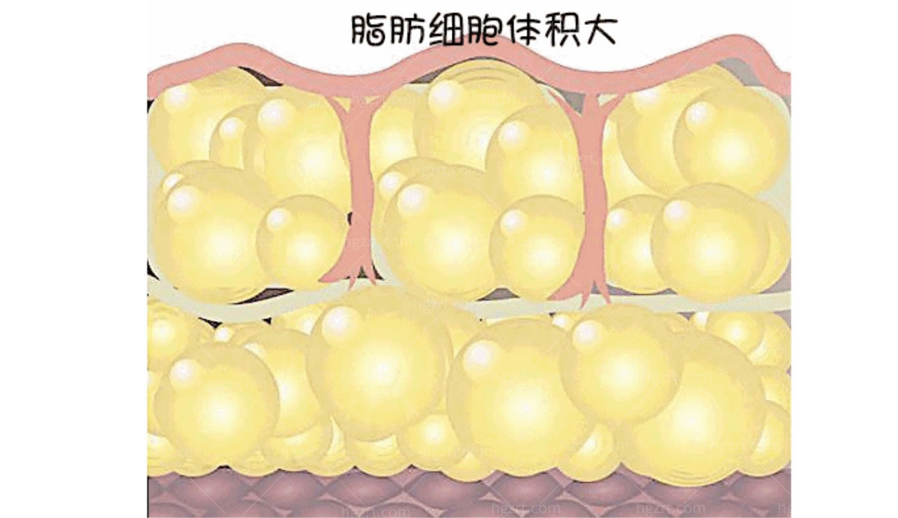 吸脂手术.jpg