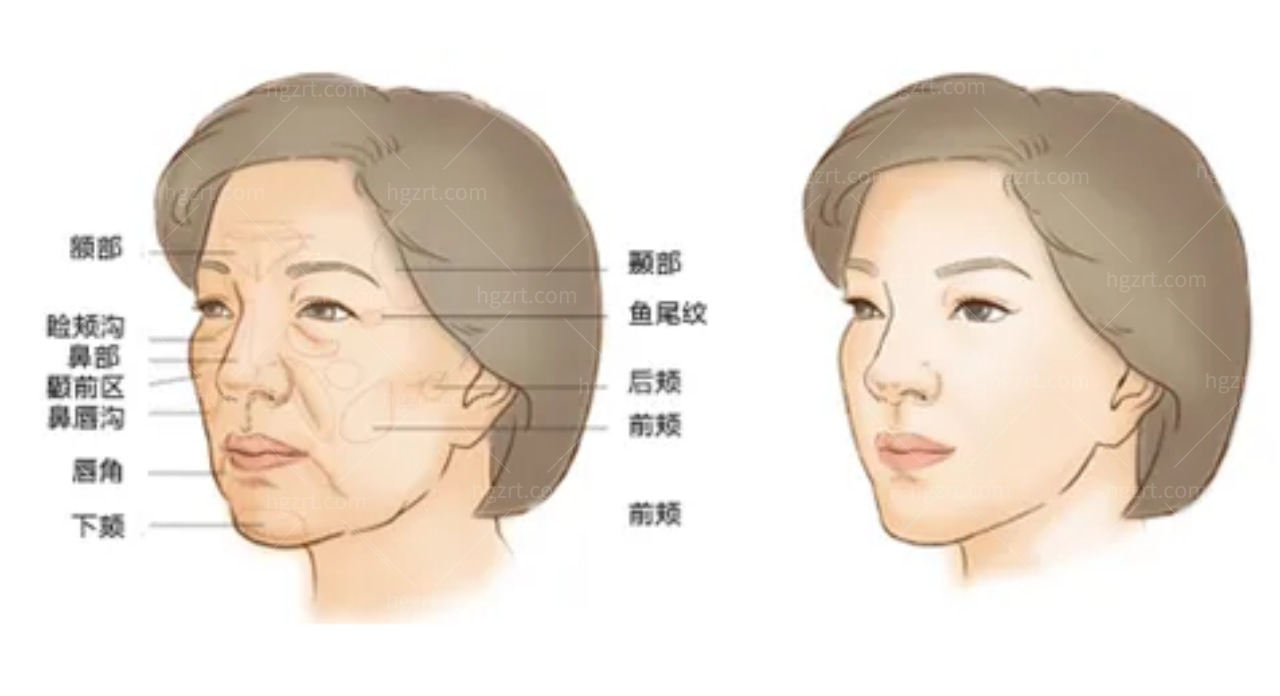 面部脂肪填充可以修饰改善的部位图