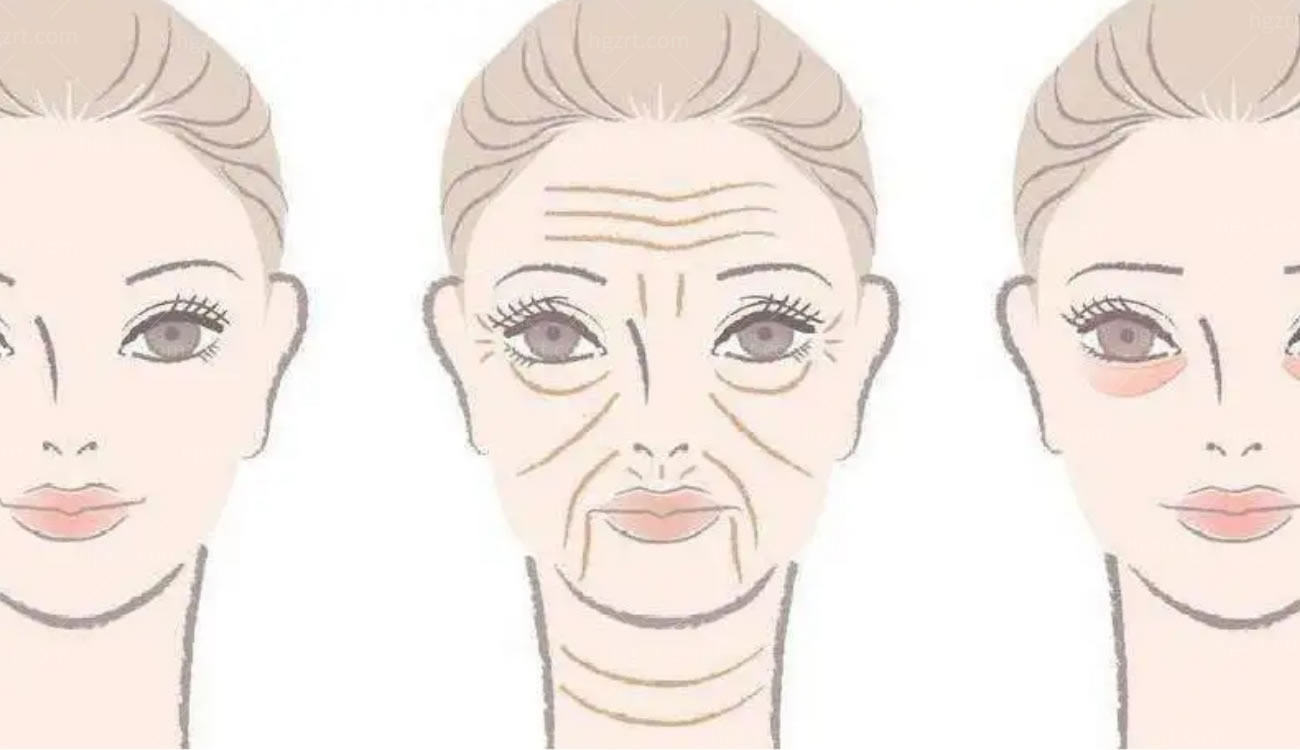 面部及颈部皱纹祛除术.jpg