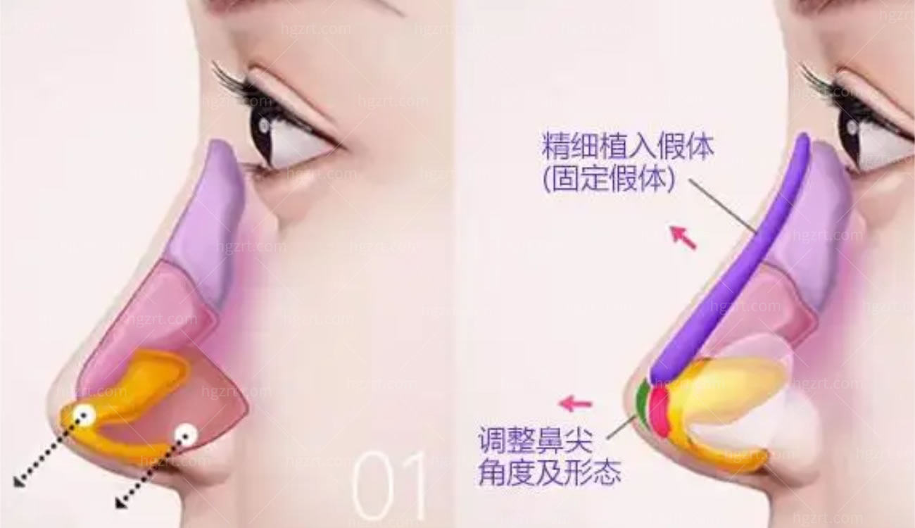 韩国鼻部整形手术.jpg