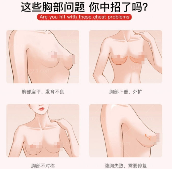 哪些人需要做胸部整形手术