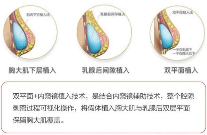 较好的内窥镜双平面丰胸技术