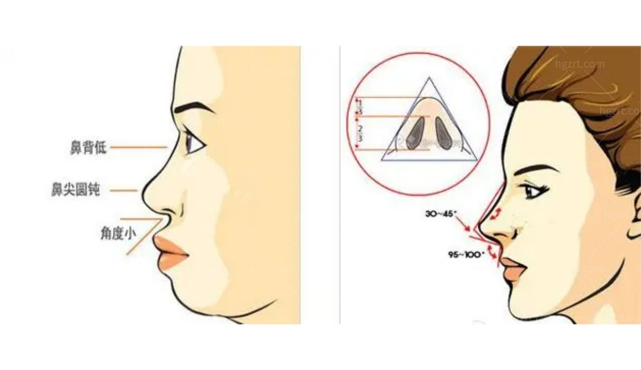 韩国隆鼻术帮你矫正驼峰鼻、 歪鼻、宽鼻、长鼻、朝天鼻.jpg