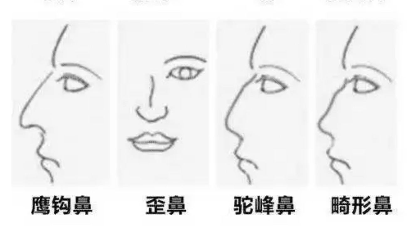 韩国隆鼻术帮你矫正驼峰鼻、 歪鼻、宽鼻、长鼻、朝天鼻.jpg