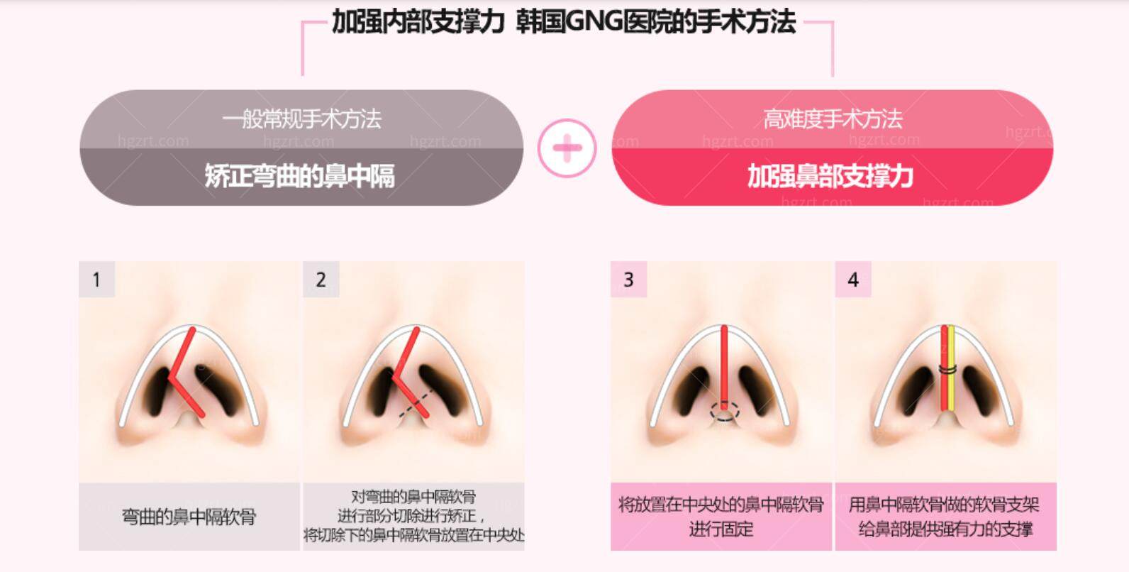 韩国GNG整形医院的鼻中隔隆鼻整形怎么样