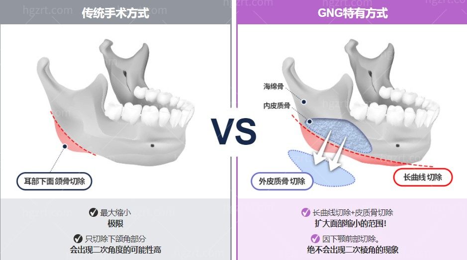 韩国GNG整形医院下颌角整形手术方法