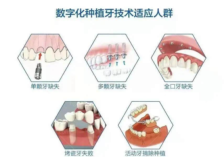 数字化种植牙适合人群