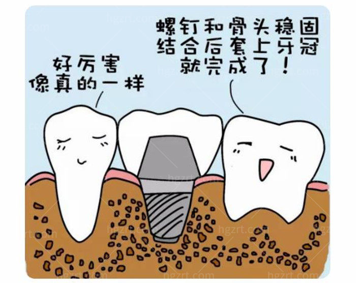 种植体卡通图