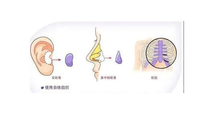 软骨隆鼻