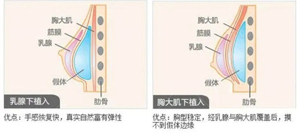 2023假体隆胸价格