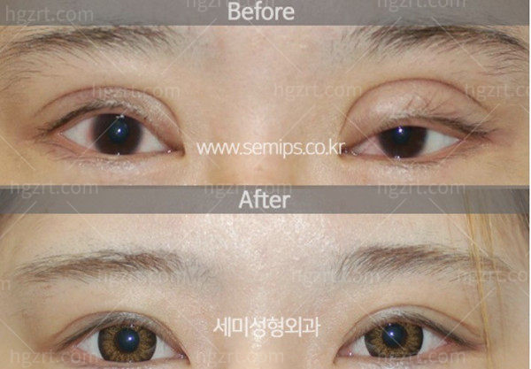韩国世美整形医院眼修复技术好吗