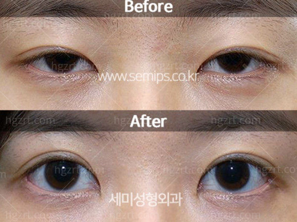 韩国世美整形医院眼修复技术好吗