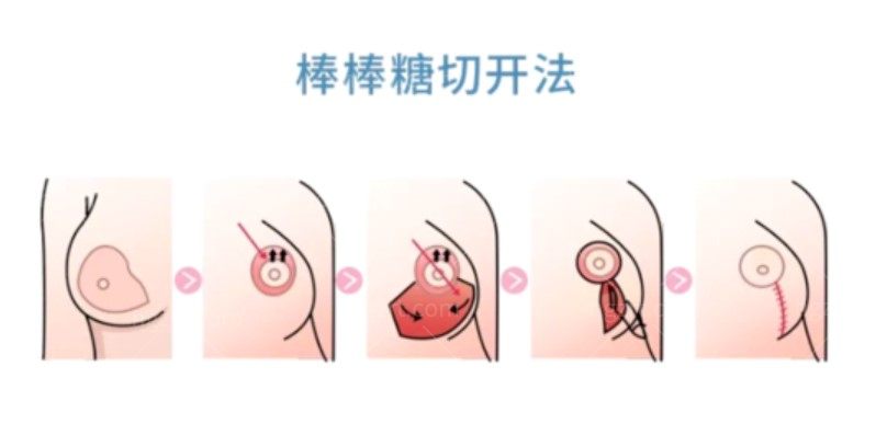 棒棒糖缩胸手术切口