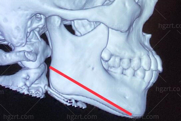 北京罗金超下颌角怎么样?据说他病例众多,做下颌角会留角