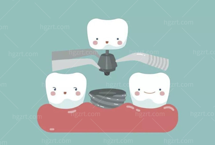 单颗种植牙卡通图