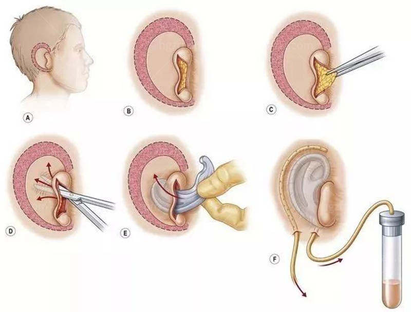 耳再造手术