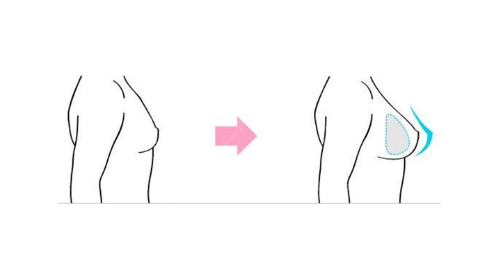 抚州梦婷整形医院隆胸技术