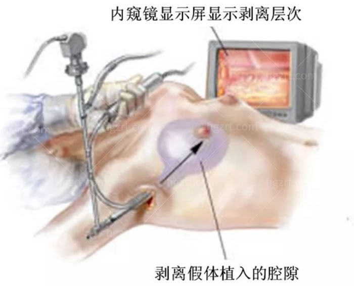 内窥镜隆胸显示器