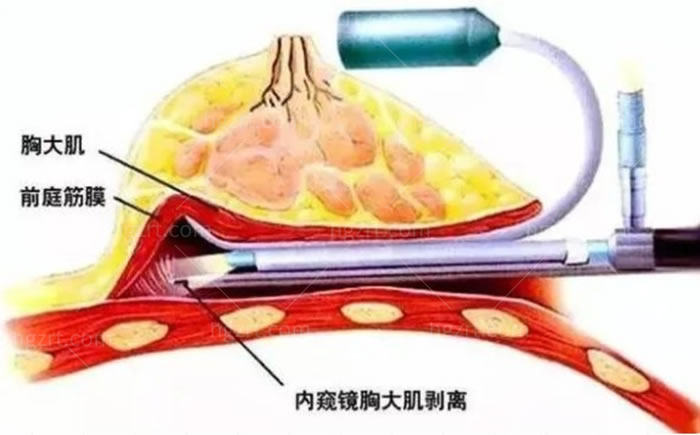 内窥镜隆胸