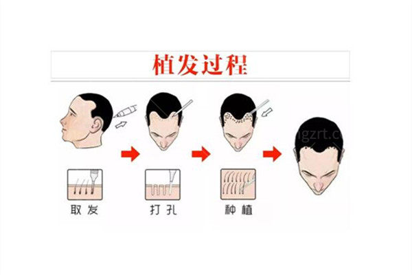 成都植发口碑好的医院排名