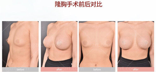 韩国VG百利酷整形隆胸手术前后对比