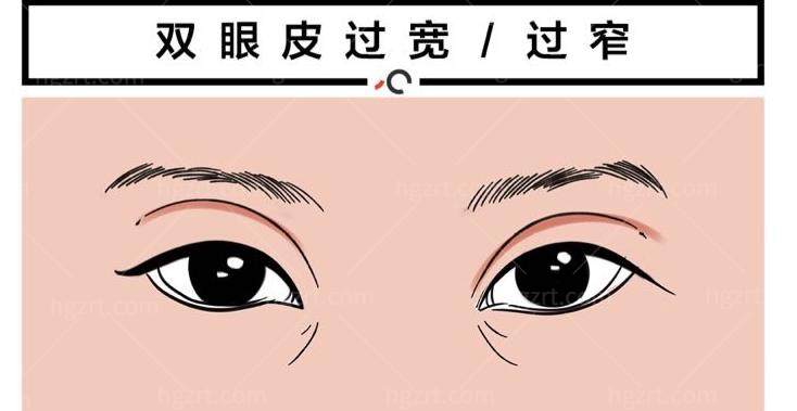 双眼皮失败