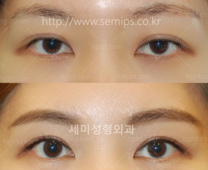韩国眼睛修复手术费用高吗