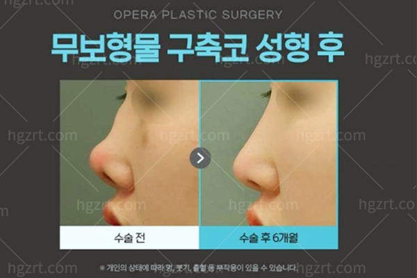韩国欧佩拉Opera整形医院鼻综合修复