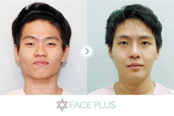 韩国faceplus整形医院面部轮廓前后对比图