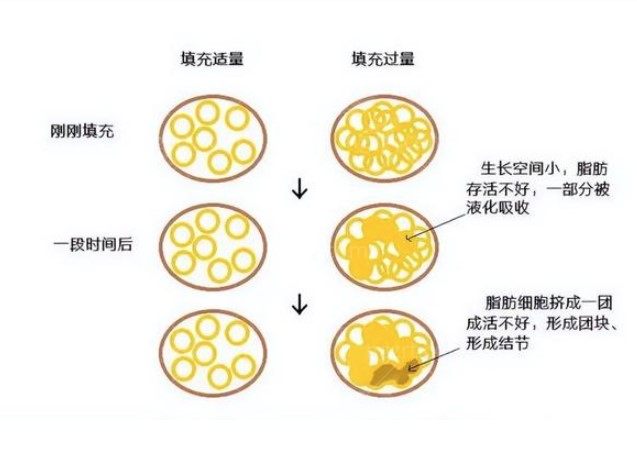 胸部填充过程照片